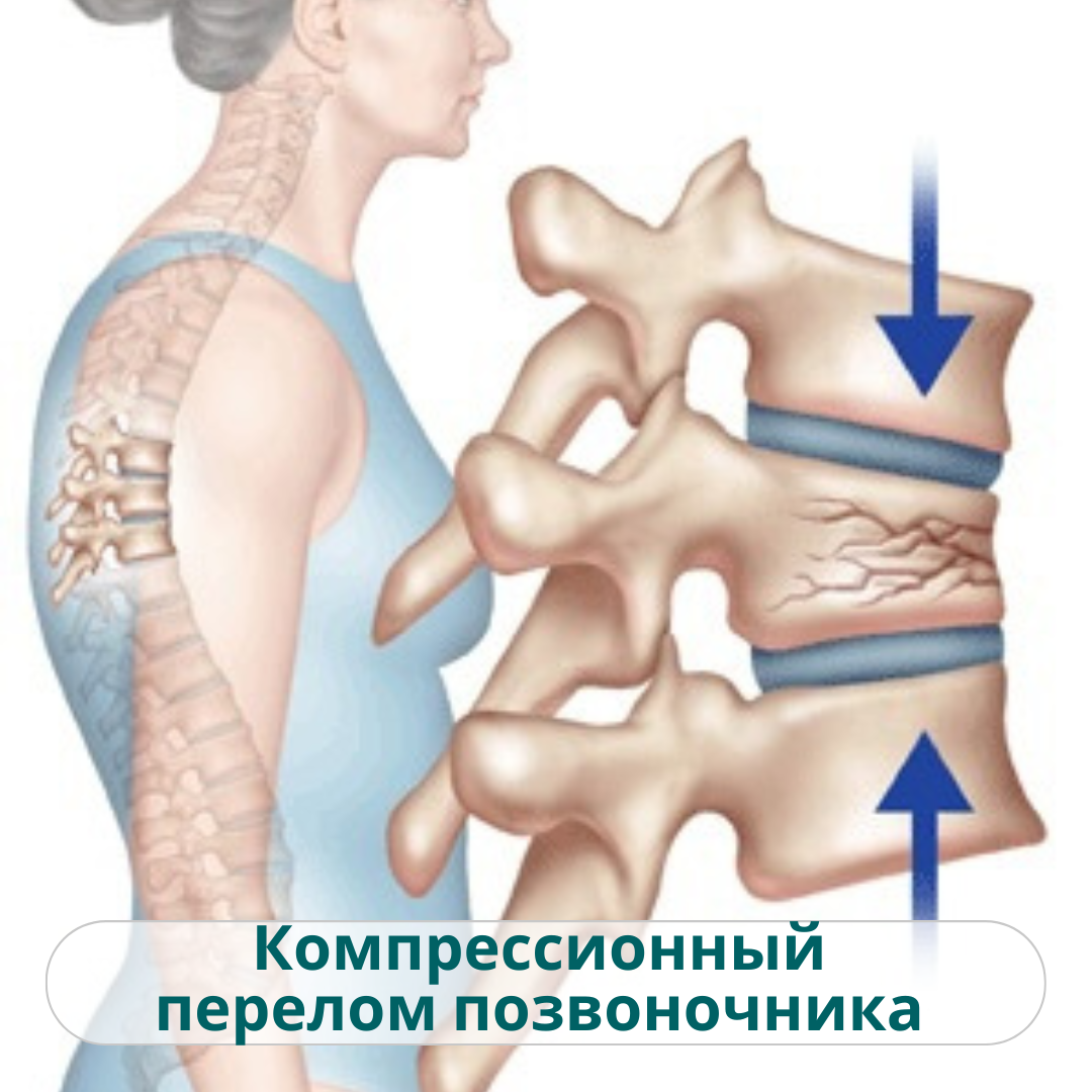 Что такое компрессионный перелом позвоночника