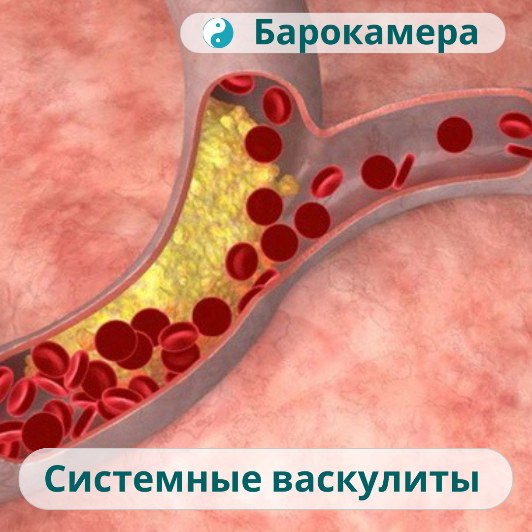 Воспаление сосудистой стенки