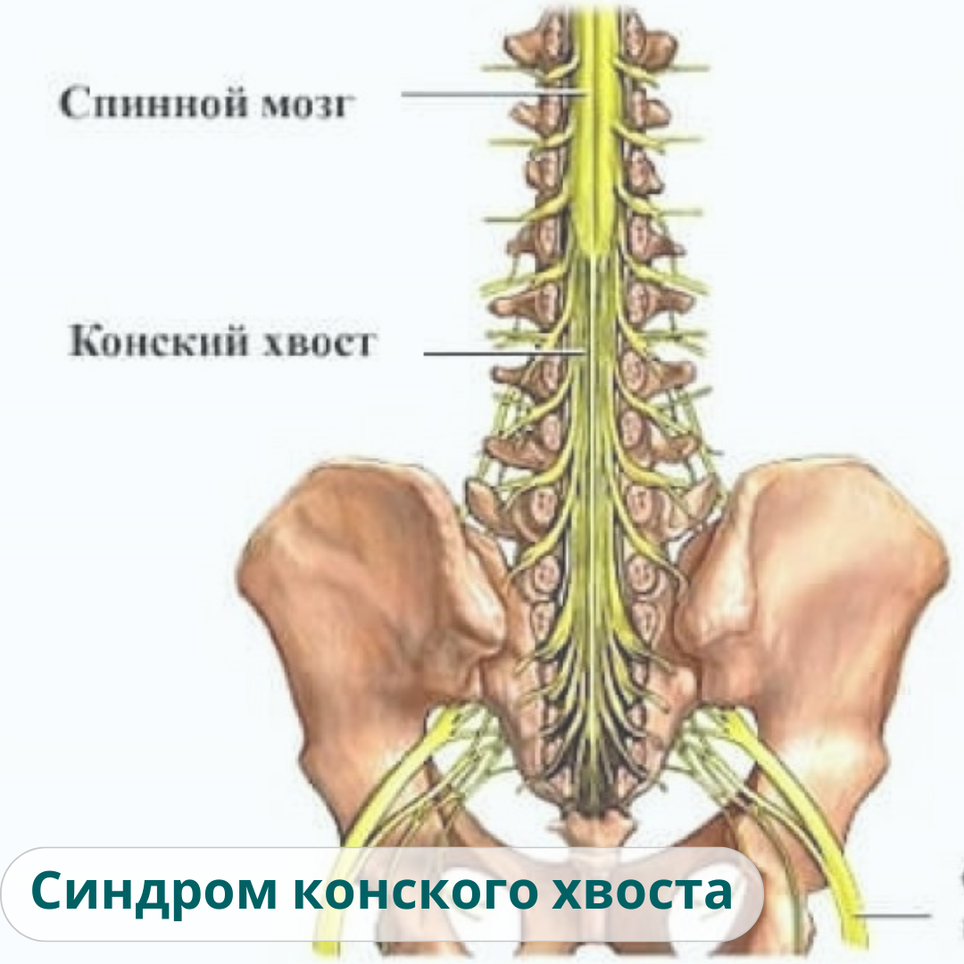 Хвост это позвоночник. Конский хвост спинного мозга. Конский хвост позвоночника.